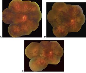 Progressive outer retinal necrosis (PORN) syndrome - American ...