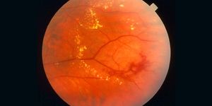 dmso vitamin c glutathione eye drops Can help with my conditions? لصقات لتفاوت لون تحت العين