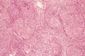 Noncaseating Definition Noncaseating granulomas - American Academy of Ophthalmology