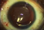 Using the Capsular Tension Segment: Tips and Pearls - American Academy ...