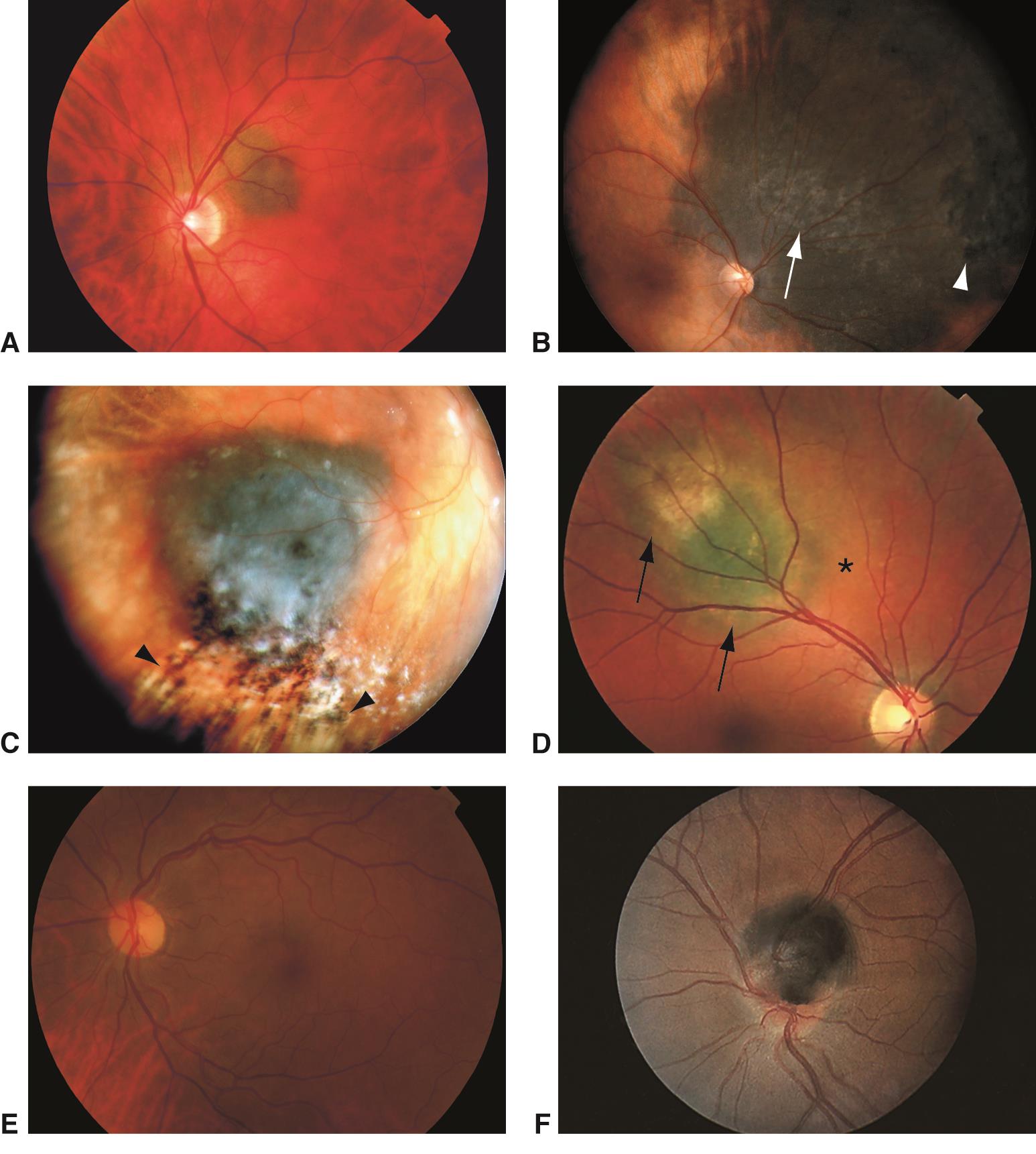melanotic pigment in retina icd 10 Choroidal nevi Protein & Fitness