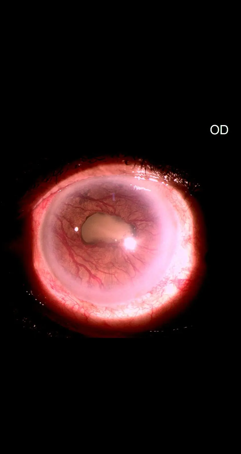 Subtle Rubeosis Rubeosis iridis and ischemic iceberg - American Academy of Ophthalmology