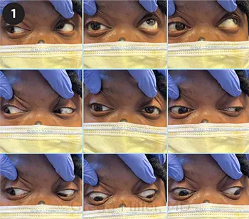 Infraduction Diagnostic Considerations in an Acquired, Isolated Third Nerve Palsy ...