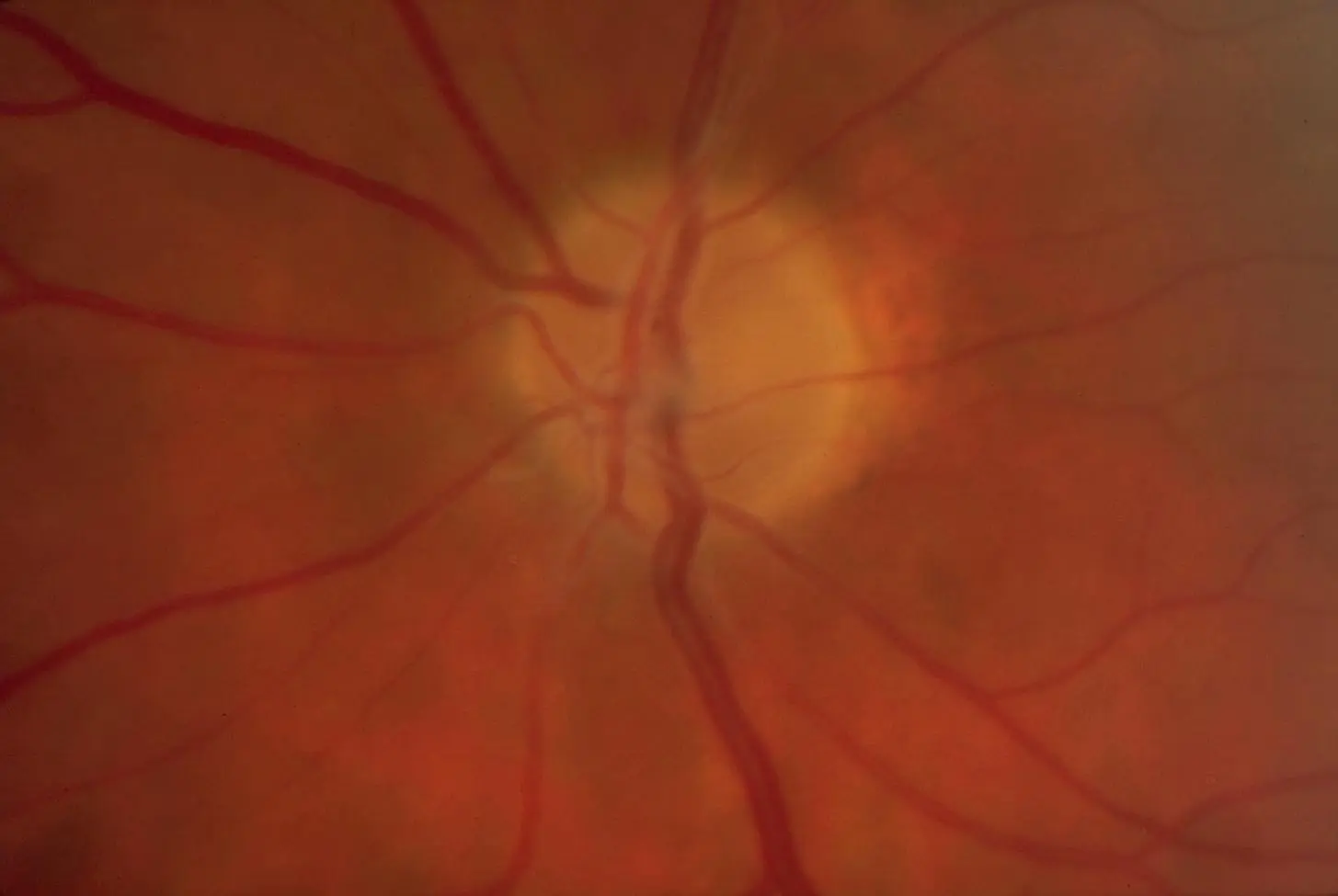 Optic disc atrophy - American Academy of Ophthalmology