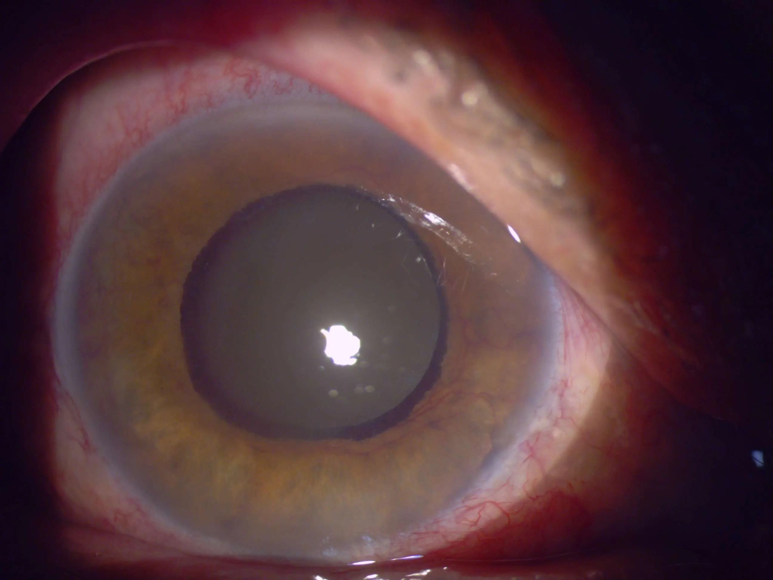 Subtle Rubeosis Rubeosis iridis - American Academy of Ophthalmology