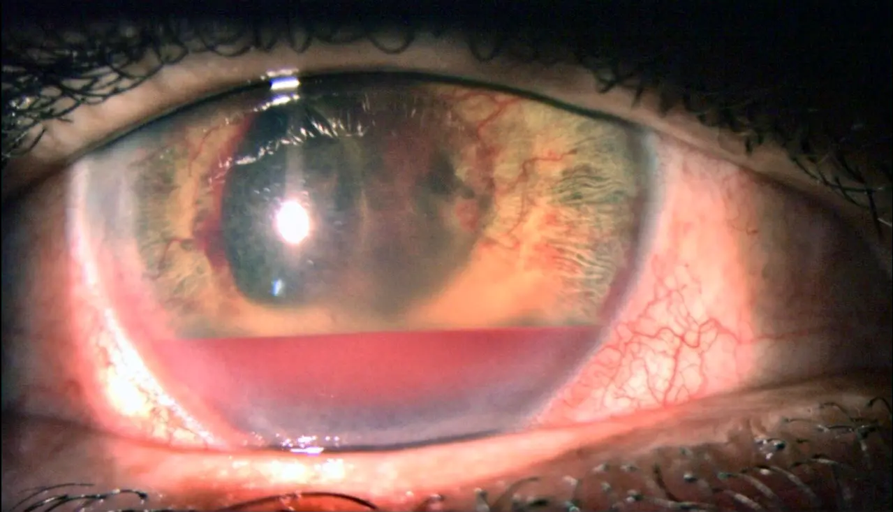 Subtle Rubeosis Rubeosis iridis with hyphema - American Academy of Ophthalmology