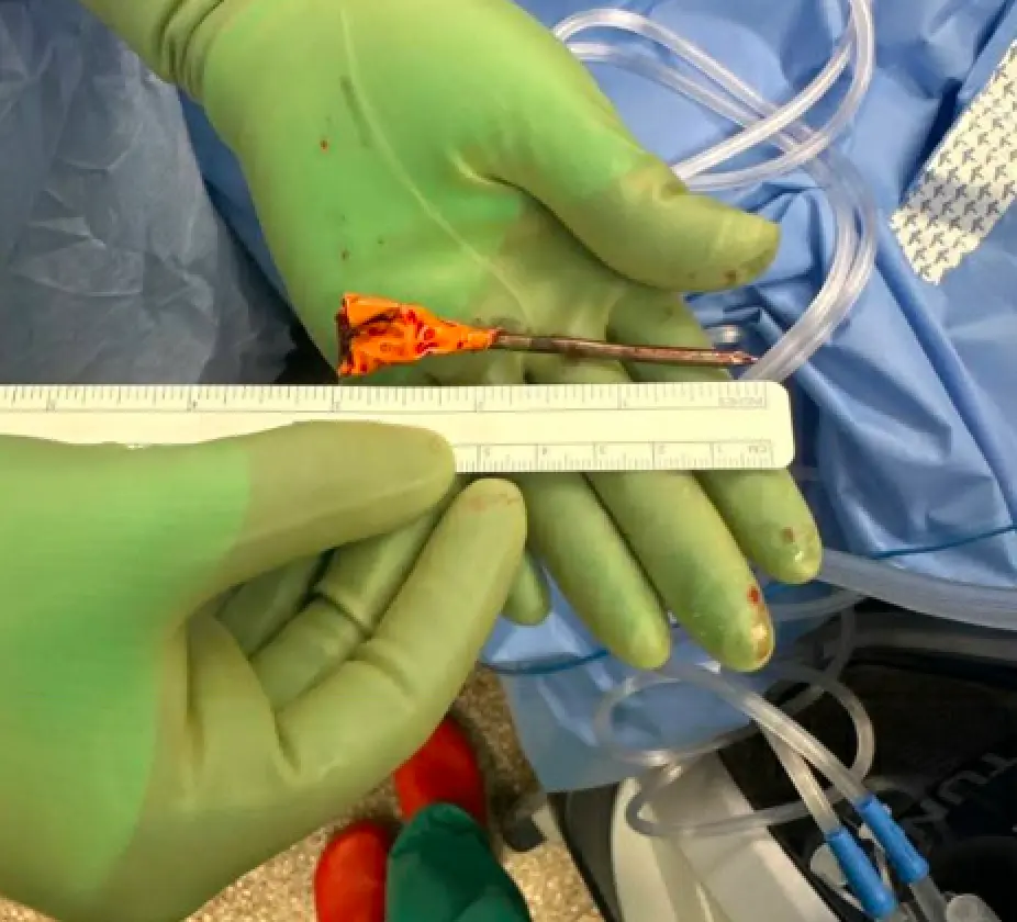 A Hair-Raising Hyphema: Beyond the Black Eye - American Academy of ...