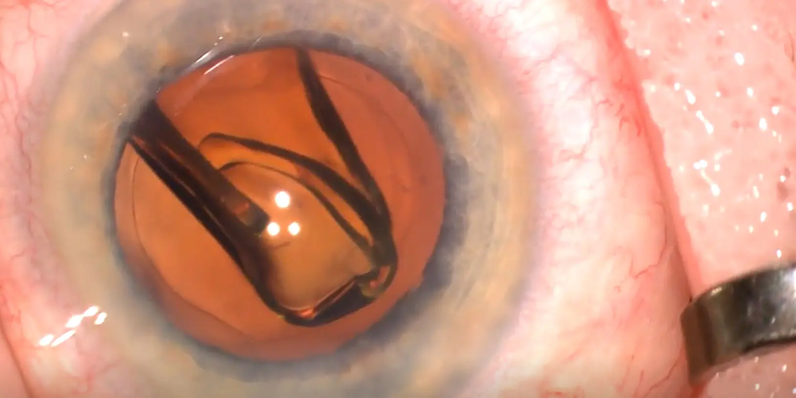 Complicated IOL Insertions - American Academy of Ophthalmology