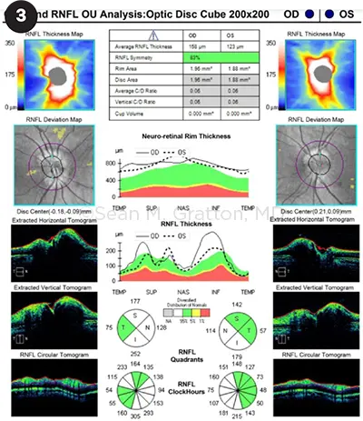 Zeizz Oct Rnfl Diagnosis and Management of Idiopathic Intracranial Hypertension ...
