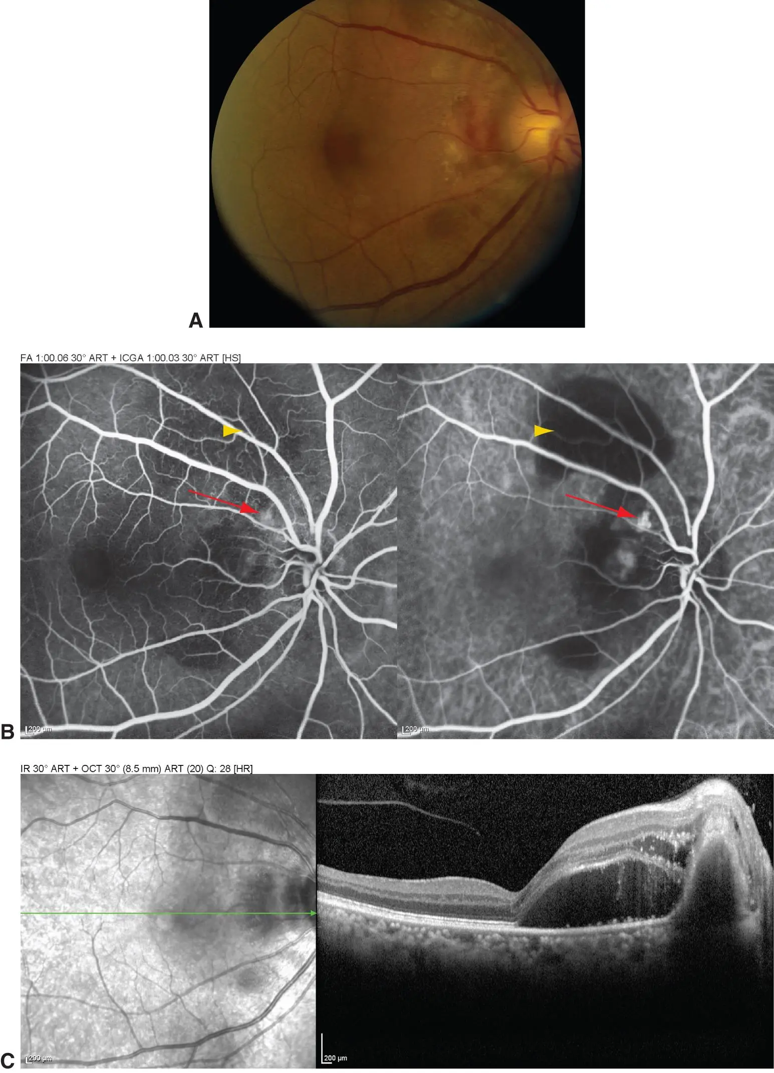 Polypoidal choroidal vasculopathy - American Academy of Ophthalmology